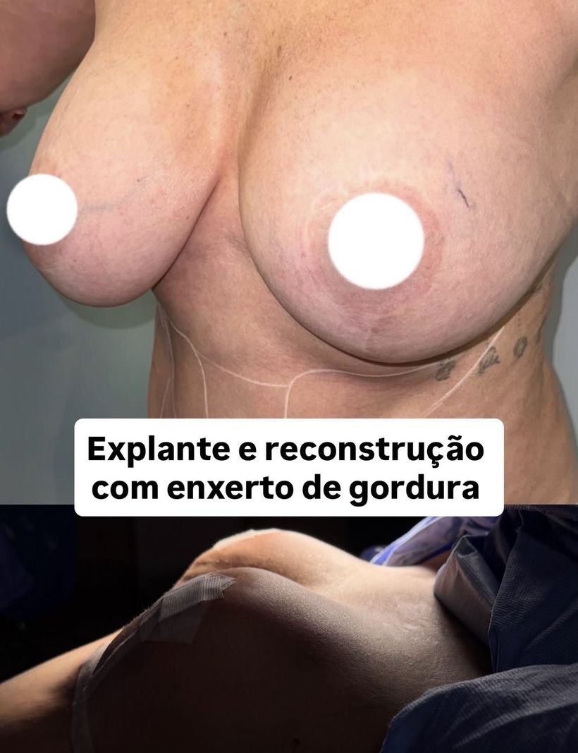 Antes e depois de explante com reconstrução por enxerto de gordura
