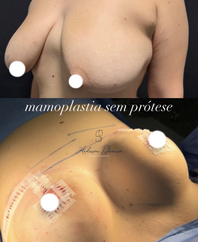 Antes e depois de mamoplastia sem prótese