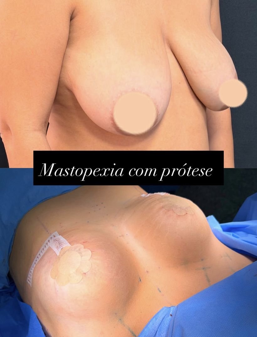Antes e depois de mastopexia com prótese