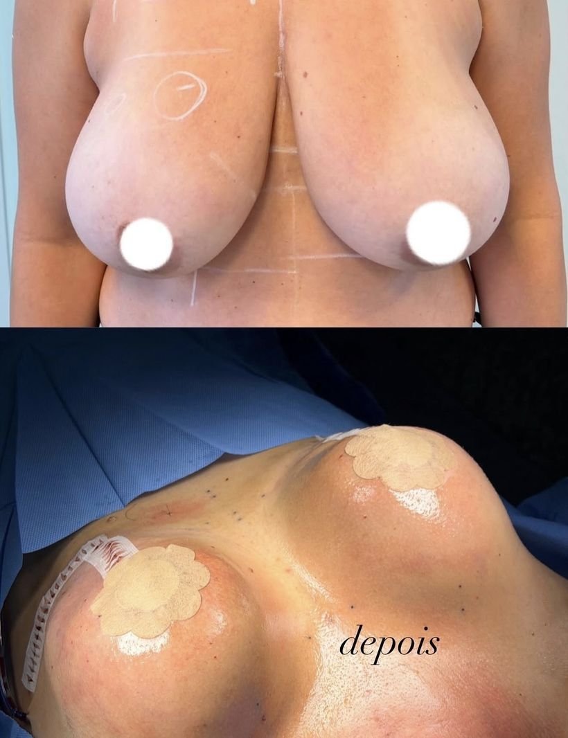 Antes e depois de cirurgia das mamas