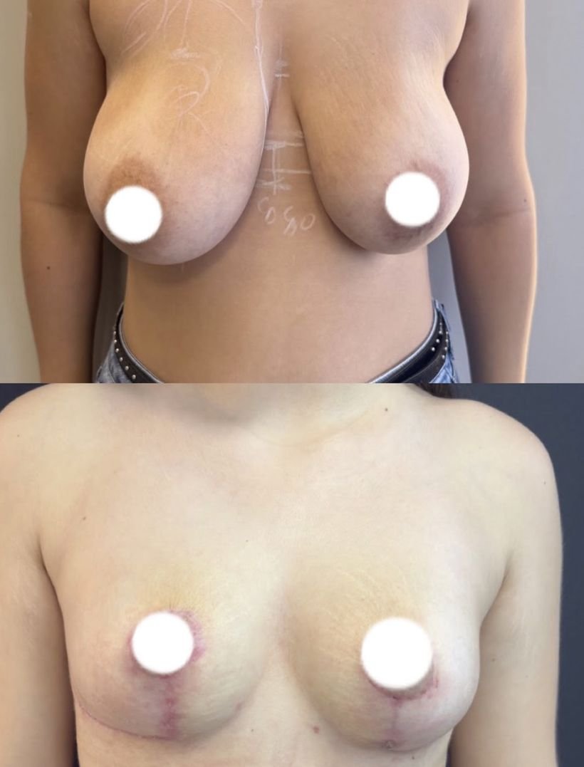 Antes e depois de cirurgia das mamas