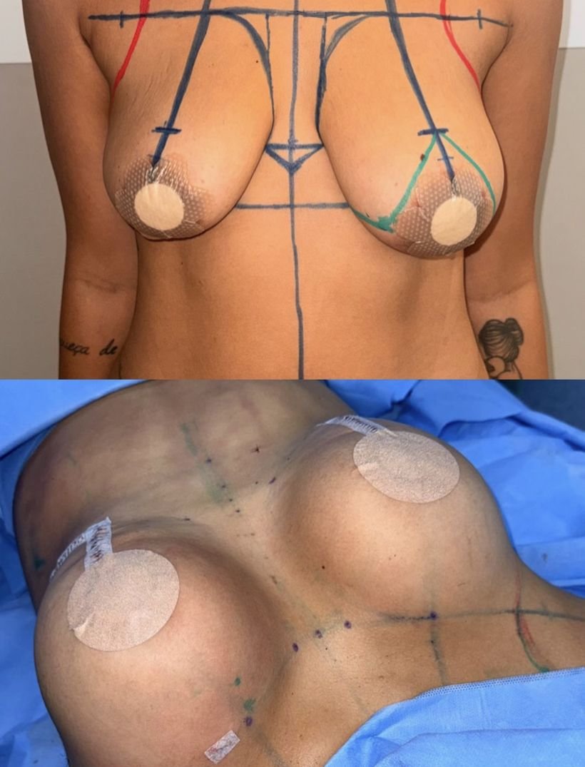 Marcação pré-operatória e resultado de cirurgia das mamas
